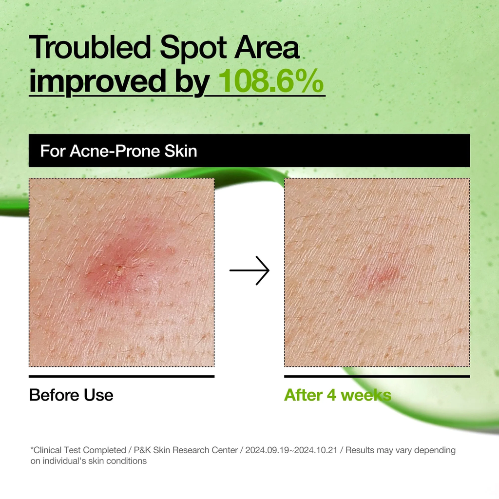 anua-us-ampoule-serum-azelaic-acid-10-hyaluron-redness-soothing-serum-1161173132.jpg.webp